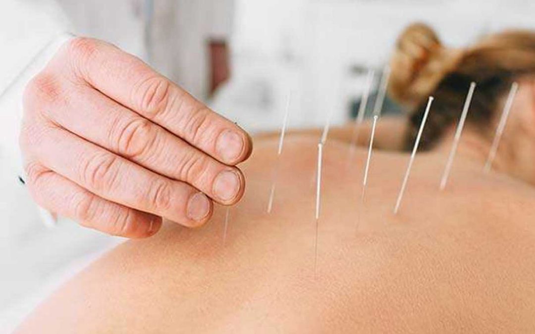 Terapia del dolore tramite agopuntura